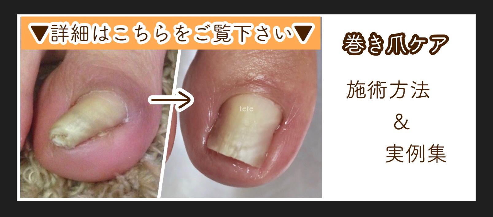ネイルサロンテテ 泉州 貝塚市のネイルサロン ジェルネイルで深爪巻き爪も美しく ネイルサロンテテ 泉州 貝塚市のネイルサロン ジェルネイルで深爪巻き爪も美しく